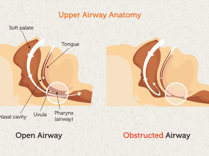 What Sleep Apnea Actually Feels Like